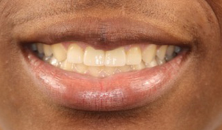 Smile Village Dental Care | Oral Cancer Screening, CBCT and Dental Bridges