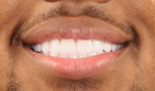 Smile Village Dental Care | All-on-6, Root Canals and LANAP reg 