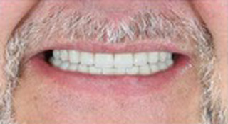 Smile Village Dental Care | Digital Radiography, Implant Restorations and Dental Bridges