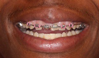 Smile Village Dental Care | All-on-6, All-on-4 reg  and Dental Sealants