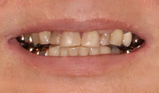 Smile Village Dental Care | Periodontal Treatment, Inlays  amp  Onlays and Extractions